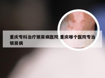 重庆专科治疗银屑病医院 重庆哪个医院专治银屑病