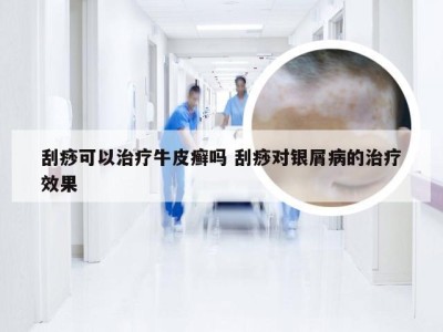 刮痧可以治疗牛皮癣吗 刮痧对银屑病的治疗效果