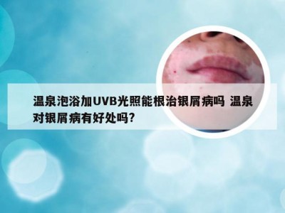 温泉泡浴加UVB光照能根治银屑病吗 温泉对银屑病有好处吗?