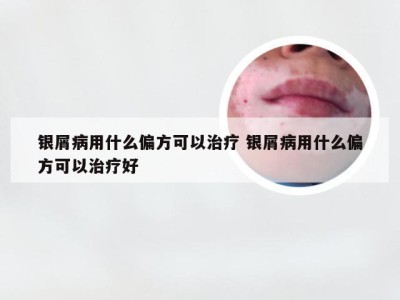 银屑病用什么偏方可以治疗 银屑病用什么偏方可以治疗好