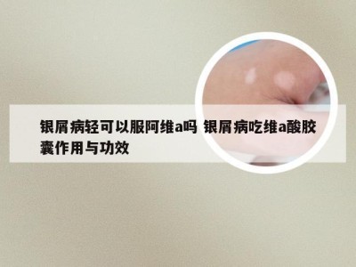 银屑病轻可以服阿维a吗 银屑病吃维a酸胶囊作用与功效