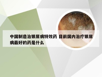 中国制造治银屑病特效药 目前国内治疗银屑病最好的药是什么