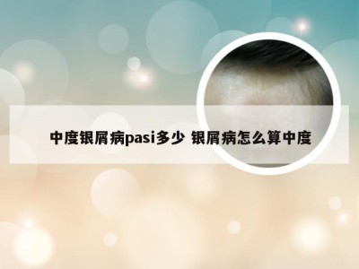 中度银屑病pasi多少 银屑病怎么算中度