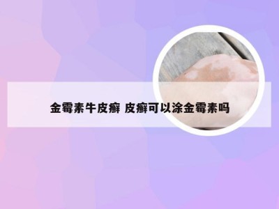 金霉素牛皮癣 皮癣可以涂金霉素吗