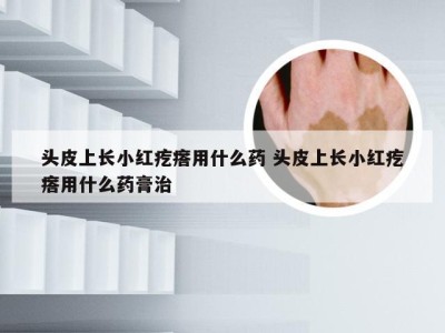 头皮上长小红疙瘩用什么药 头皮上长小红疙瘩用什么药膏治