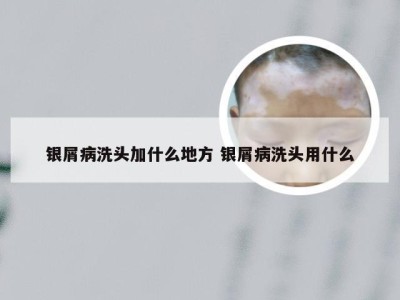 银屑病洗头加什么地方 银屑病洗头用什么