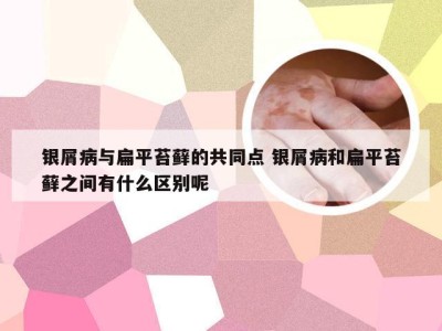 银屑病与扁平苔藓的共同点 银屑病和扁平苔藓之间有什么区别呢