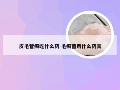 皮毛管癣吃什么药 毛癣菌用什么药膏