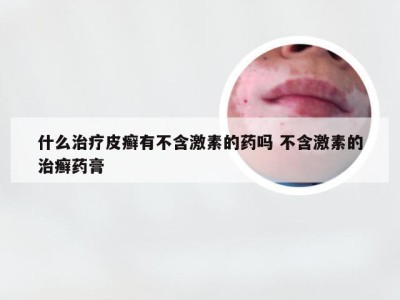 什么治疗皮癣有不含激素的药吗 不含激素的治癣药膏