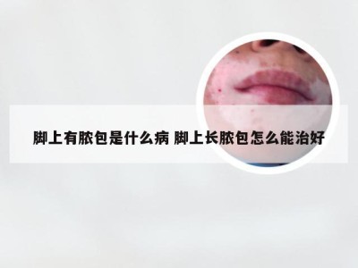 脚上有脓包是什么病 脚上长脓包怎么能治好