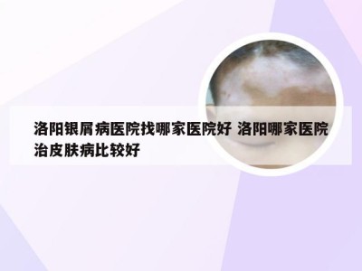 洛阳银屑病医院找哪家医院好 洛阳哪家医院治皮肤病比较好