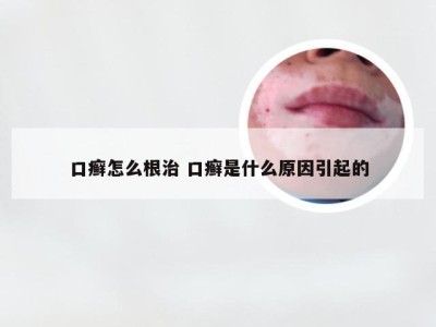 口癣怎么根治 口癣是什么原因引起的