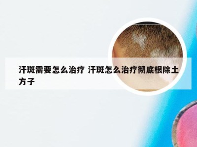 汗斑需要怎么治疗 汗斑怎么治疗彻底根除土方子