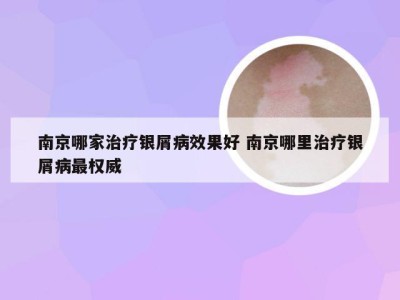 南京哪家治疗银屑病效果好 南京哪里治疗银屑病最权威