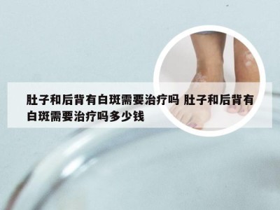 肚子和后背有白斑需要治疗吗 肚子和后背有白斑需要治疗吗多少钱