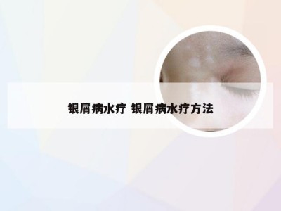 银屑病水疗 银屑病水疗方法