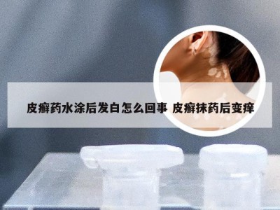 皮癣药水涂后发白怎么回事 皮癣抹药后变痒