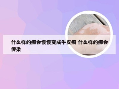 什么样的癣会慢慢变成牛皮癣 什么样的癣会传染