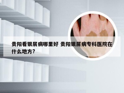 贵阳看银屑病哪里好 贵阳银屑病专科医院在什么地方?