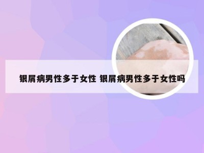 银屑病男性多于女性 银屑病男性多于女性吗