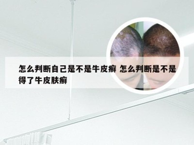 怎么判断自己是不是牛皮癣 怎么判断是不是得了牛皮肤癣