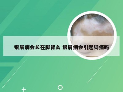 银屑病会长在脚背么 银屑病会引起脚痛吗