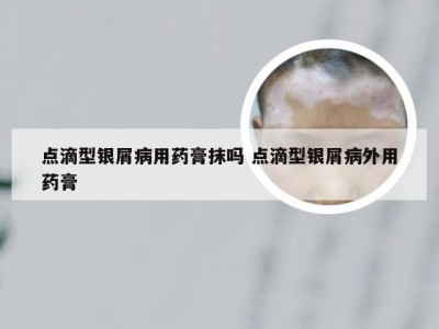 点滴型银屑病用药膏抹吗 点滴型银屑病外用药膏