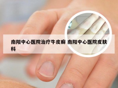 南阳中心医院治疗牛皮癣 南阳中心医院皮肤科