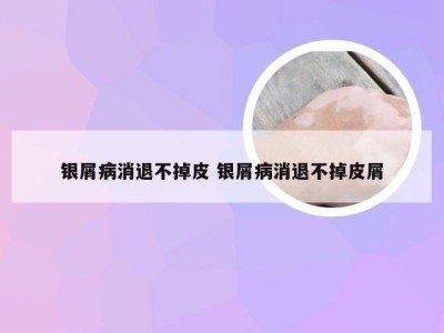 银屑病消退不掉皮 银屑病消退不掉皮屑