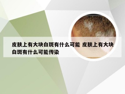 皮肤上有大块白斑有什么可能 皮肤上有大块白斑有什么可能传染