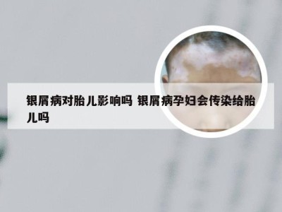 银屑病对胎儿影响吗 银屑病孕妇会传染给胎儿吗