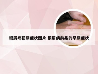 银屑病初期症状图片 银屑病前兆的早期症状