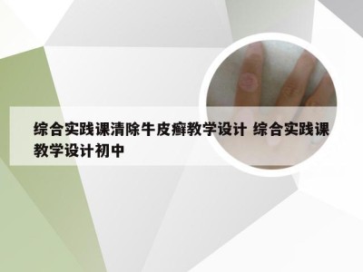 综合实践课清除牛皮癣教学设计 综合实践课教学设计初中