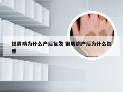 银屑病为什么产后复发 银屑病产后为什么加重