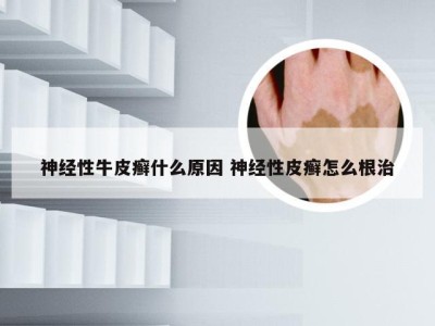 神经性牛皮癣什么原因 神经性皮癣怎么根治