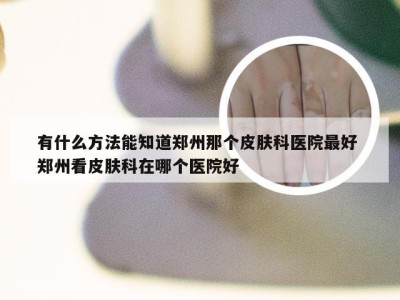 有什么方法能知道郑州那个皮肤科医院最好 郑州看皮肤科在哪个医院好