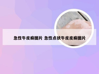 急性牛皮癣图片 急性点状牛皮皮癣图片