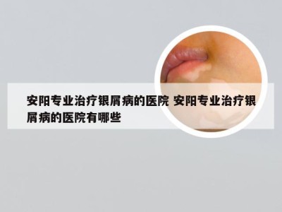 安阳专业治疗银屑病的医院 安阳专业治疗银屑病的医院有哪些