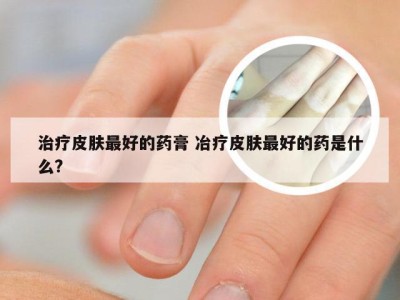 治疗皮肤最好的药膏 冶疗皮肤最好的药是什么?