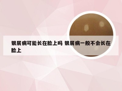 银屑病可能长在脸上吗 银屑病一般不会长在脸上