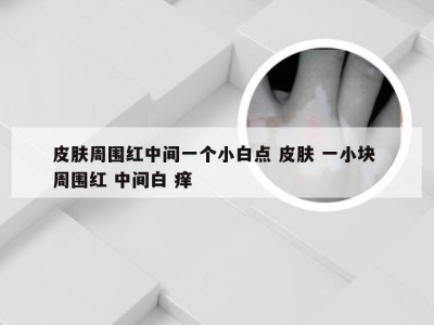 皮肤周围红中间一个小白点 皮肤 一小块 周围红 中间白 痒