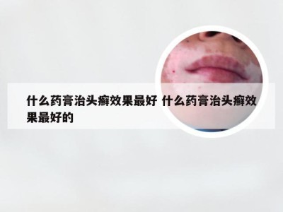 什么药膏治头癣效果最好 什么药膏治头癣效果最好的