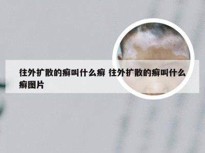 往外扩散的癣叫什么癣 往外扩散的癣叫什么癣图片