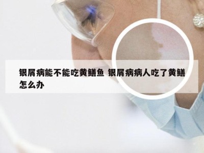 银屑病能不能吃黄鳝鱼 银屑病病人吃了黄鳝怎么办