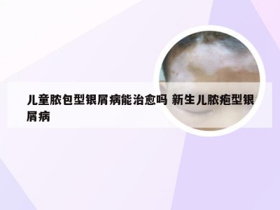 儿童脓包型银屑病能治愈吗 新生儿脓疱型银屑病