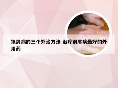 银屑病的三个外治方法 治疗银屑病最好的外用药