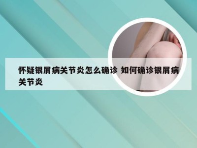 怀疑银屑病关节炎怎么确诊 如何确诊银屑病关节炎