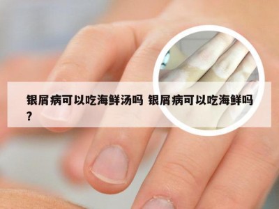 银屑病可以吃海鲜汤吗 银屑病可以吃海鲜吗?