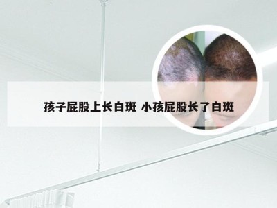 孩子屁股上长白斑 小孩屁股长了白斑