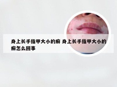 身上长手指甲大小的癣 身上长手指甲大小的癣怎么回事